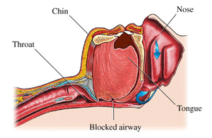 OSA Obstructed Airway
